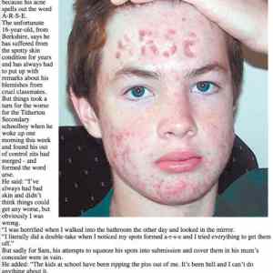 Obrázek 'Trolled by acne'