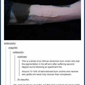 Obrázek 'burn&nbsp;victim'