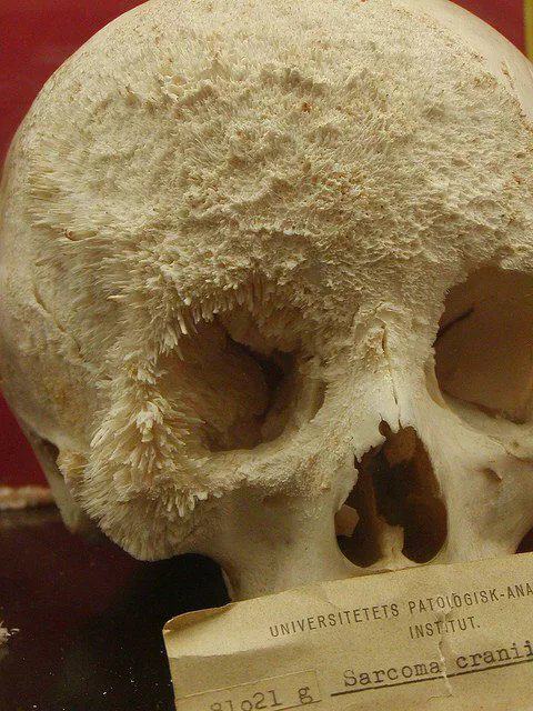 Obrázek Bone cancer from nightmares