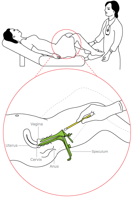 Obrázek Jak se to dela - PAP a HPV test