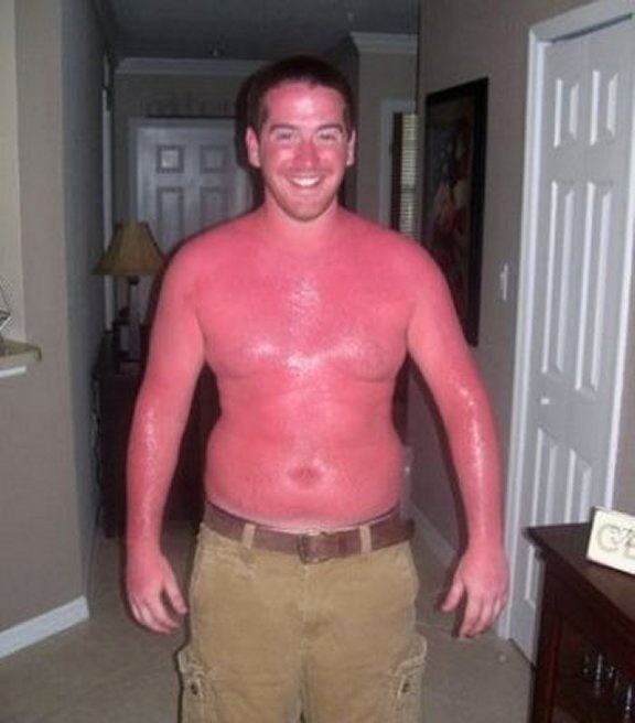 Obrázek Thats Some Serious Sunburn