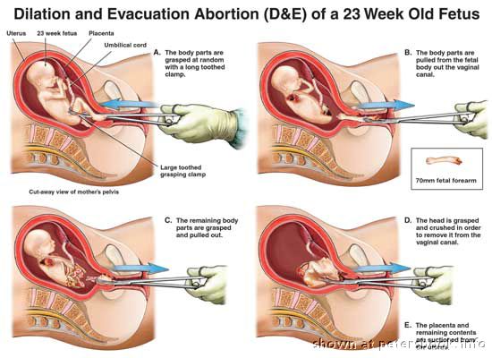 Obrázek potrat